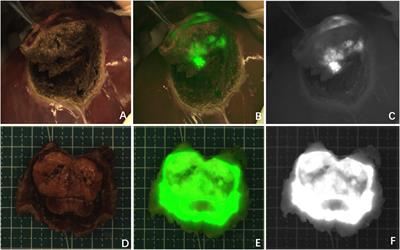 Tumor-Background Ratio is an effective method to identify tumors and false-positive nodules in indocyanine-green navigation surgery for pediatric liver cancer